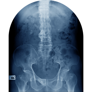 Xray showing Ankylosing Spondylitis