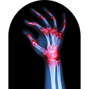 Xray of Osteoarthritis in the hand